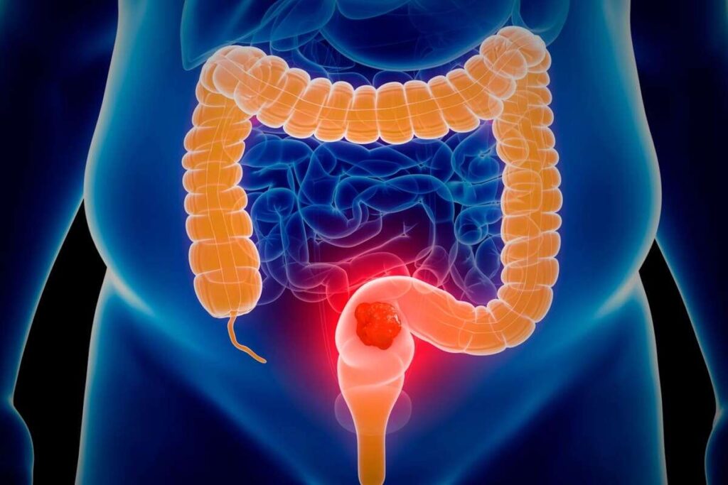 Črevesje, rak na debelem črevesju